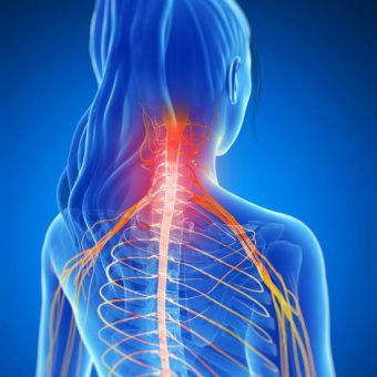 Pinched Spinal Nerve (Cervical Radiculopathy): Treatment in Fairfax, VA ...