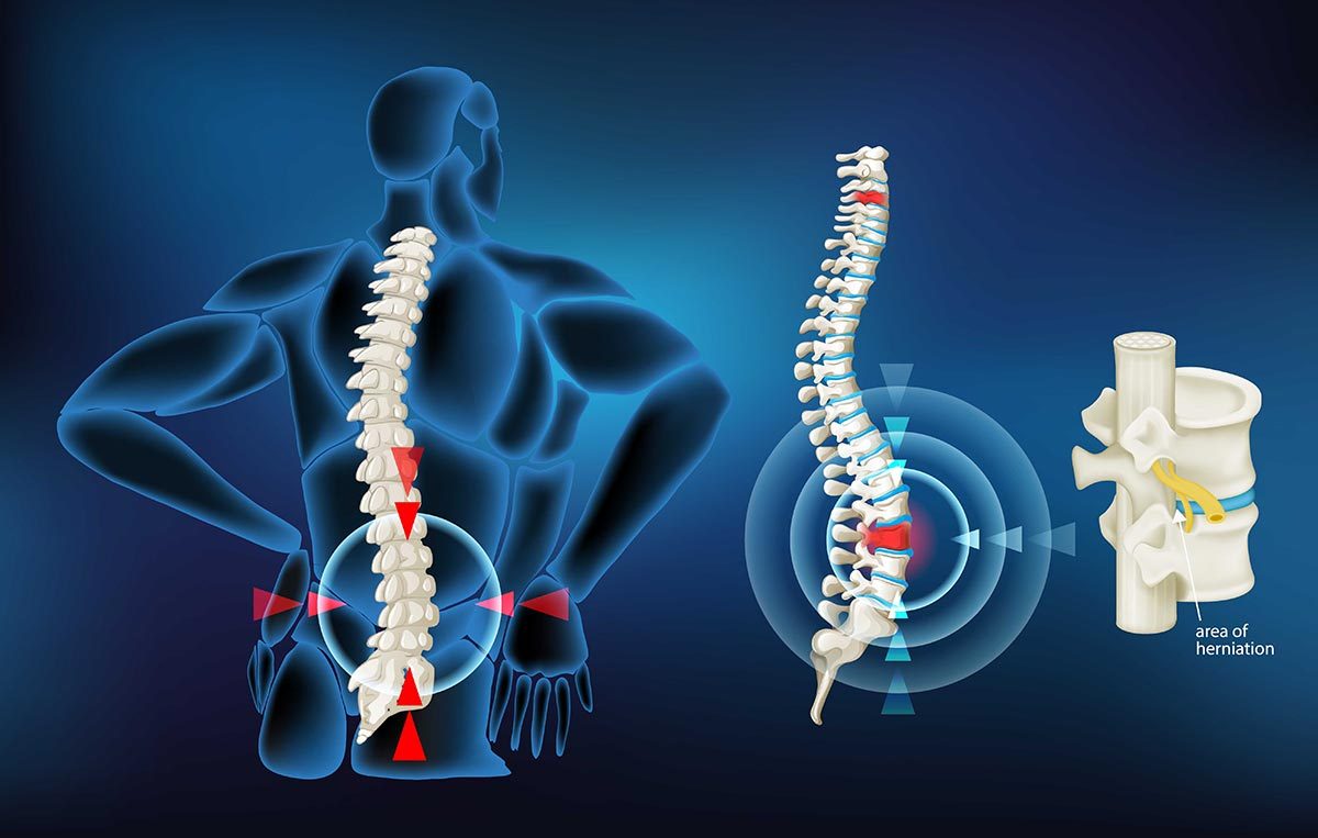 Herniated Disk: Treatment at SAPNA: Spine and Pain Clinic of North