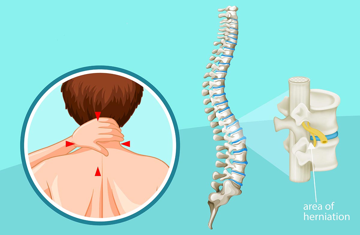 Pinched Spinal Nerve Cervical Radiculopathy Treatment In Fairfax VA 