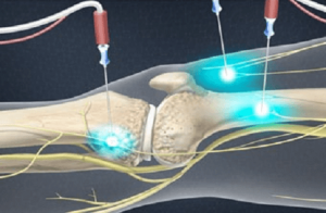 Genicular Nerve Radiofrequency Ablation for Chronic Knee Pain | Spine ...