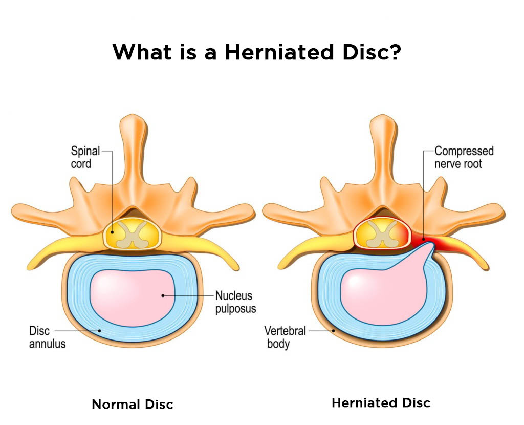 disc herniation exercises