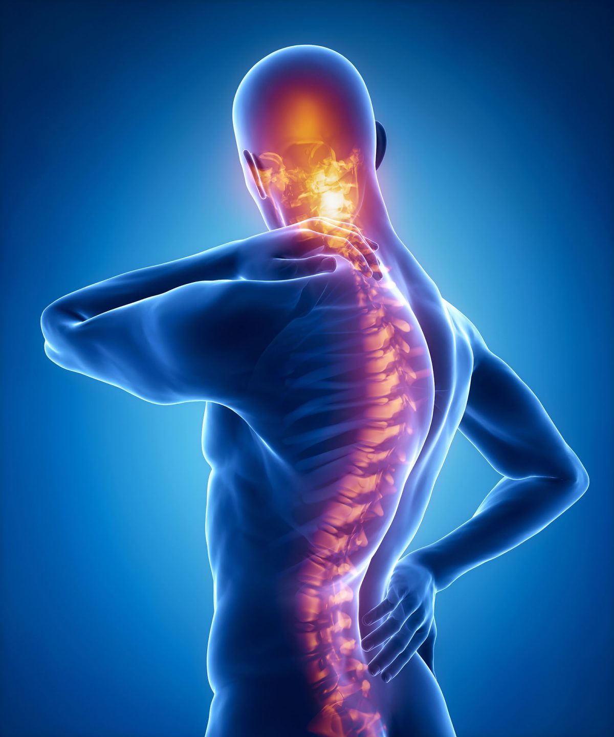 Scheuermann's Disease: Treatment in Fairfax, VA | SAPNA: Spine and Pain