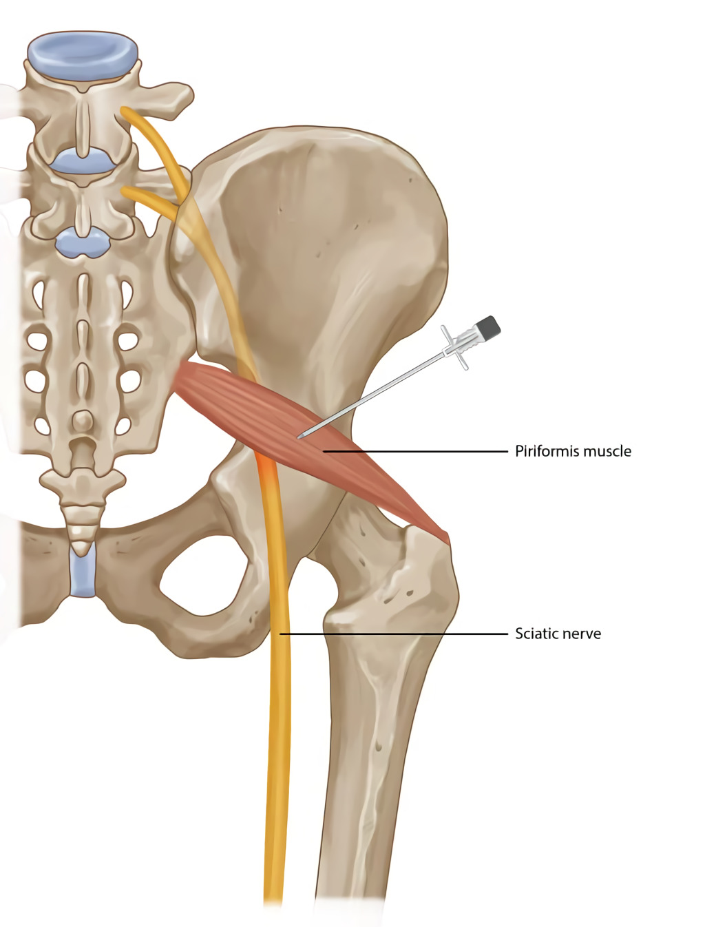 Piriformis syndrome causes and treatment with 6 exercises