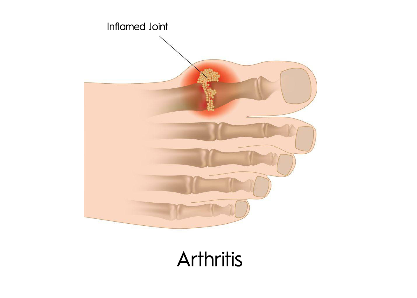 What Causes Heel Pain? – SAPNA: Spine and Pain Clinic of North America