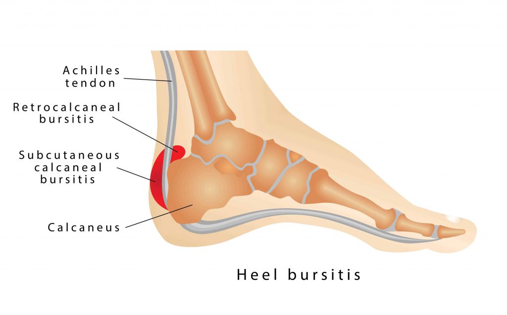 High Heels & Your Foot Health