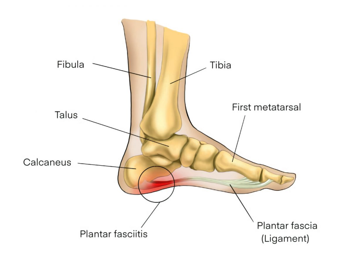 What Causes Heel Pain? – SAPNA: Spine and Pain Clinic of North America