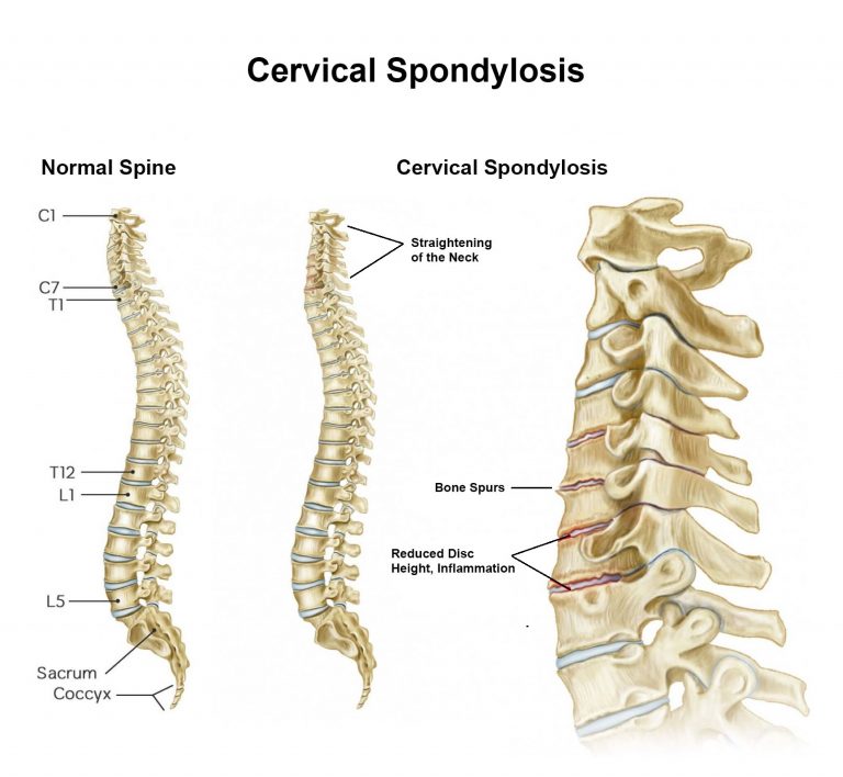 Cervical Spondylosis Treatment in Fairfax, VA and Potomac, MD | Spine ...