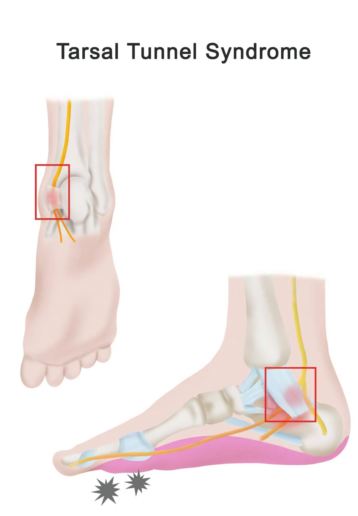 tarsal-tunnel-syndrome-treatment-in-fairfax-va-sapna-spine-and