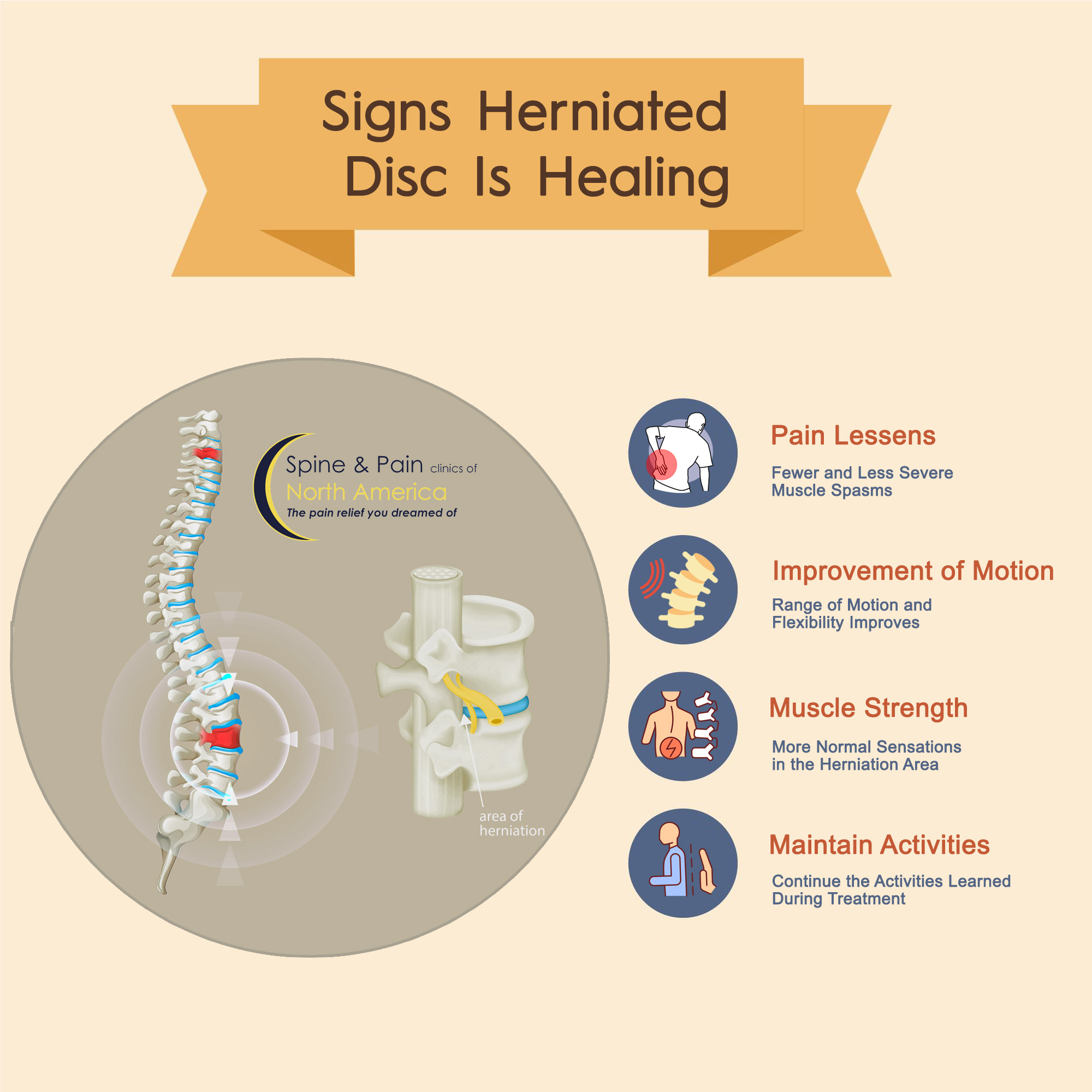 Signs Herniated Disc Is Healing
