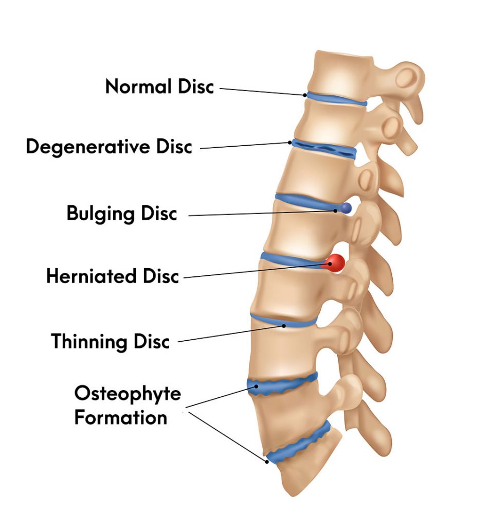 Types of Disc Herniation