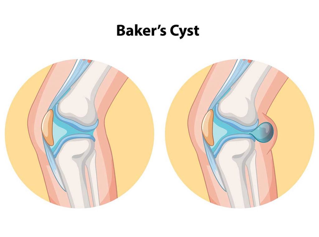 Baker’s cyst